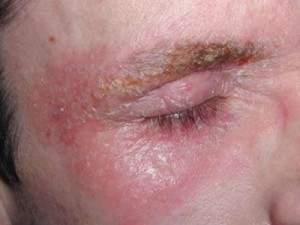Dermatitis seborreica. / http://www.teleclinicaonline.com