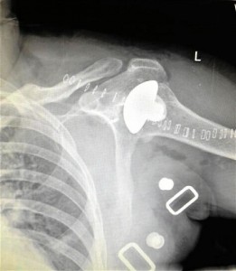Imagen del menisco insertado en el hombro del paciente.