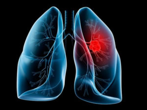 Cáncer de pulmón. / http://www.medciencia.com