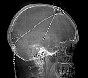 Radiografía del cráneo de un sujeto