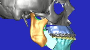 Reconstrucción de una mandíbula mediante técnicas 3D