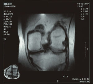 Radiografía de una rodilla con artrosis. / Foto: Europa Press.