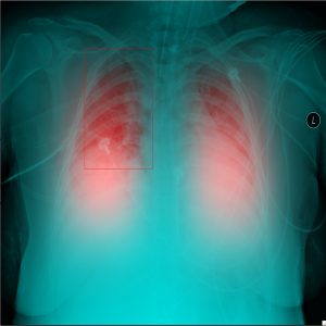 CSIC desarrolla un ecógrafo pulmonar para la detección temprana Covid-19