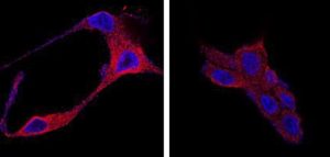 Tratamiento para el cáncer de próstata que usa nanopartículas orgánicas